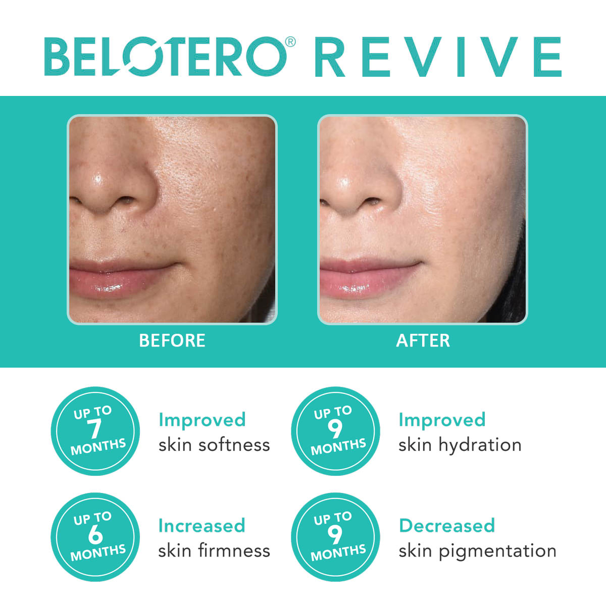 BELOTERO REVIVE(彩虹針)