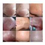 REMOVE BLACKHEADS DESINCRUSTATION SOLUTION